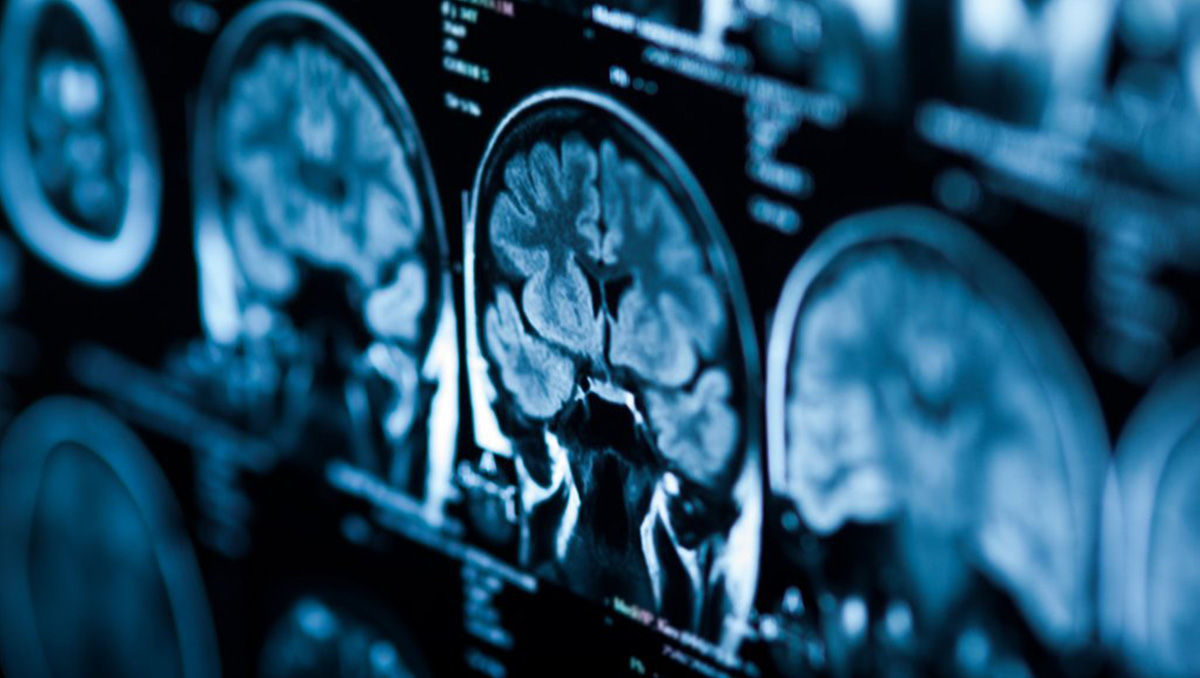 diagnóstico de la epilepsia