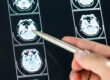 Muerte súbita por epilepsia